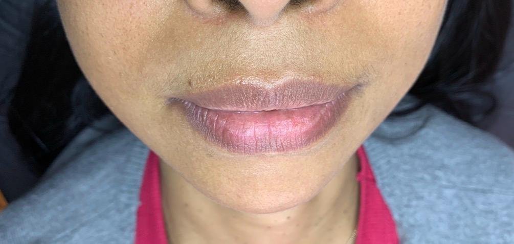 Lábios antes da neutralização labial